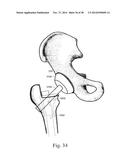 METHODS AND SYSTEMS FOR HIP REPLACEMENT diagram and image