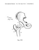 METHODS AND SYSTEMS FOR HIP REPLACEMENT diagram and image