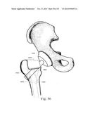 METHODS AND SYSTEMS FOR HIP REPLACEMENT diagram and image