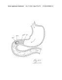 LUMINAL PROSTHESIS AND A GASTROINTESTINAL IMPLANT DEVICE diagram and image