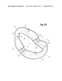 INCREMENTAL AND/OR SUCCESSIVE ADJUSTABLE MANDIBULAR ADVANCEMENT DEVICE FOR     PREVENTING AND TREATMENT OF SNORING AND OBSTRUCTIVE SLEEP APNEA diagram and image