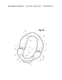 INCREMENTAL AND/OR SUCCESSIVE ADJUSTABLE MANDIBULAR ADVANCEMENT DEVICE FOR     PREVENTING AND TREATMENT OF SNORING AND OBSTRUCTIVE SLEEP APNEA diagram and image