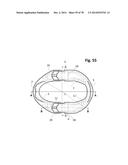 INCREMENTAL AND/OR SUCCESSIVE ADJUSTABLE MANDIBULAR ADVANCEMENT DEVICE FOR     PREVENTING AND TREATMENT OF SNORING AND OBSTRUCTIVE SLEEP APNEA diagram and image