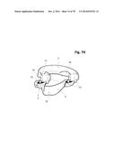 INCREMENTAL AND/OR SUCCESSIVE ADJUSTABLE MANDIBULAR ADVANCEMENT DEVICE FOR     PREVENTING AND TREATMENT OF SNORING AND OBSTRUCTIVE SLEEP APNEA diagram and image