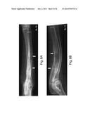 BMP-1 Procollagen C-Proteinase for Diagnosis and Treatment of Bone and     Soft Tissue Defects and Disorders diagram and image