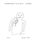 Tunneled Catheter with Hemostasis Mechanism diagram and image