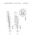 ADJUSTABLE CATHETER FOR OSTIAL, SEPTAL, AND ROOF ABLATION IN ATRIAL     FIBRILLATION PATIENTS diagram and image