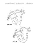 ADJUSTABLE CATHETER FOR OSTIAL, SEPTAL, AND ROOF ABLATION IN ATRIAL     FIBRILLATION PATIENTS diagram and image