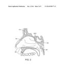 DEVICES AND METHODS FOR INSERTING A SINUS DILATOR diagram and image