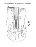 INSTRUMENT FOR INSERTING AN INTERSPINOUS PROCESS IMPLANT diagram and image