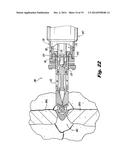 INSTRUMENT FOR INSERTING AN INTERSPINOUS PROCESS IMPLANT diagram and image