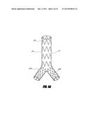 STENT GRAFT diagram and image