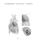 PLATFORMS FOR MITRAL VALVE REPLACEMENT diagram and image