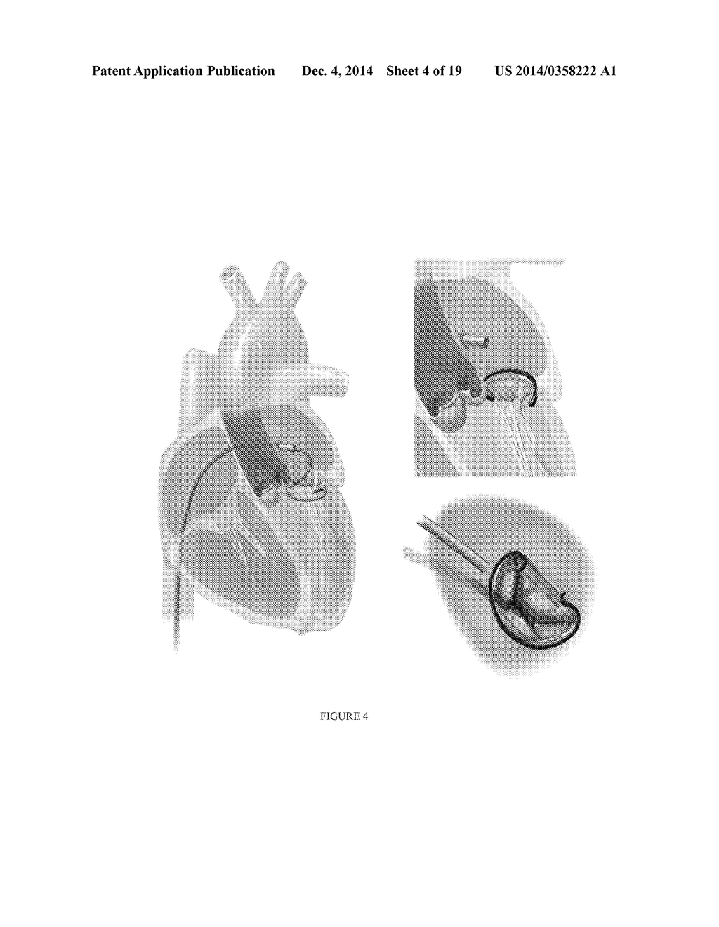 PLATFORMS FOR MITRAL VALVE REPLACEMENT - diagram, schematic, and image 05