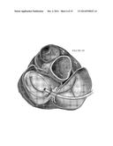 PLATFORMS FOR MITRAL VALVE REPLACEMENT diagram and image