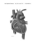 PLATFORMS FOR MITRAL VALVE REPLACEMENT diagram and image