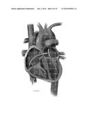 PLATFORMS FOR MITRAL VALVE REPLACEMENT diagram and image