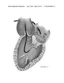 PLATFORMS FOR MITRAL VALVE REPLACEMENT diagram and image