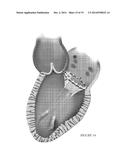 PLATFORMS FOR MITRAL VALVE REPLACEMENT diagram and image