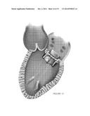 PLATFORMS FOR MITRAL VALVE REPLACEMENT diagram and image