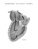 PLATFORMS FOR MITRAL VALVE REPLACEMENT diagram and image