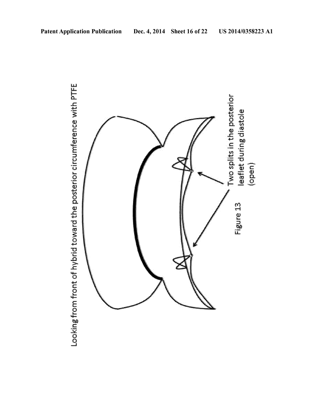 PROSTHESES - diagram, schematic, and image 17