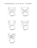 METHODS AND APPARATUS FOR AN OSTEOTOMY FIXATION OR ARTHRODESIS CAGE diagram and image