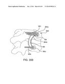 SYSTEMS, DEVICES AND APPARATUSES FOR BONY FIXATION AND DISK REPAIR AND     REPLACEMENT METHODS RELATED THERETO diagram and image