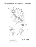 CUSTOMIZED ORTHODONTIC BRACKET SYSTEM diagram and image