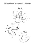 METHOD FOR MAKING AN IMPRESSION TRAY FOR DENTAL USE diagram and image