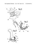 METHOD FOR MAKING AN IMPRESSION TRAY FOR DENTAL USE diagram and image