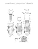 Expandable dental implant and method of use diagram and image