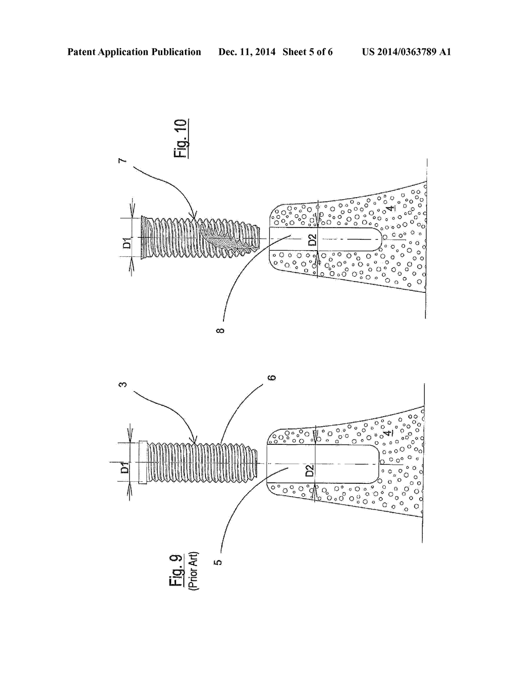 Endosseous implant of the improved type - diagram, schematic, and image 06