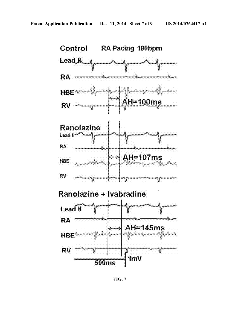 METHOD OF TREATING ATRIAL FIBRILLATION - diagram, schematic, and image 08