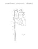 Electrophysiology/ablation catheter having lariat configuration of     variable radius diagram and image