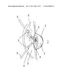 METHOD, APPARATUS, AND A SYSTEM FOR ROBOTIC ASSISTED CATARACT SURGERY diagram and image