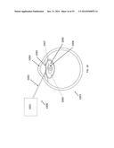 METHOD, APPARATUS, AND A SYSTEM FOR ROBOTIC ASSISTED CATARACT SURGERY diagram and image