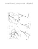 Minimally Invasive Repair of a Valve Leaflet in a Beating Heart diagram and image