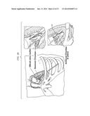 Minimally Invasive Repair of a Valve Leaflet in a Beating Heart diagram and image