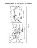 Minimally Invasive Repair of a Valve Leaflet in a Beating Heart diagram and image