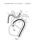 Methods And Devices For Embolic Protection diagram and image