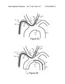 Methods And Devices For Embolic Protection diagram and image