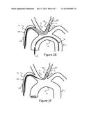 Methods And Devices For Embolic Protection diagram and image