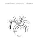 Methods And Devices For Embolic Protection diagram and image