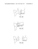 Pericardial Devices, Systems and Methods for Occluding an Atrial Appendage diagram and image