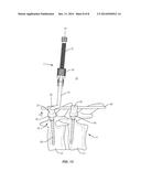 SPINAL CORRECTION SYSTEM diagram and image