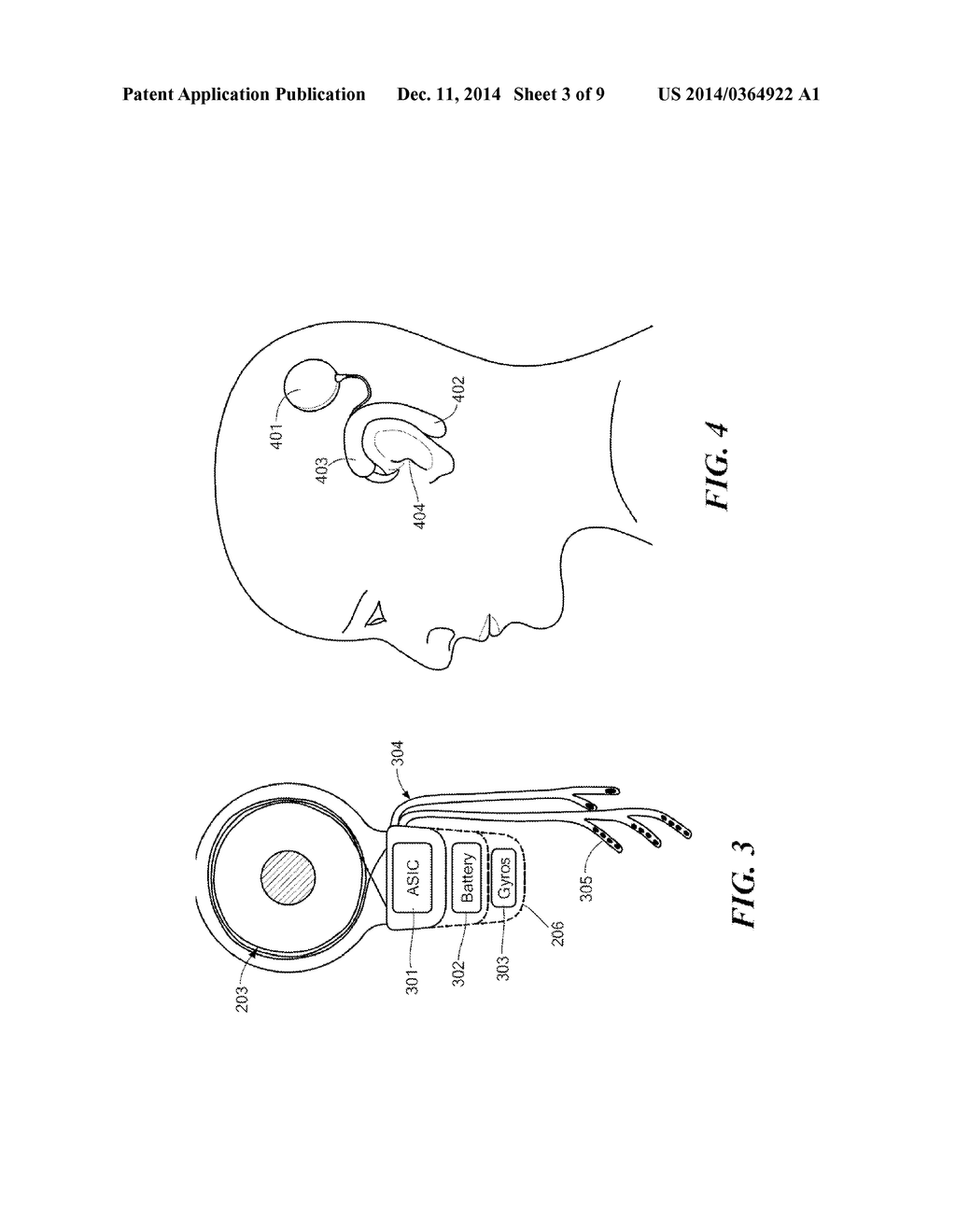 Vestibular Implant System with Internal and External Motion Sensors - diagram, schematic, and image 04