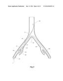 INTRODUCER FOR AN ILIAC SIDE BRANCH DEVICE diagram and image