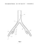 INTRODUCER FOR AN ILIAC SIDE BRANCH DEVICE diagram and image