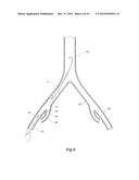 INTRODUCER FOR AN ILIAC SIDE BRANCH DEVICE diagram and image